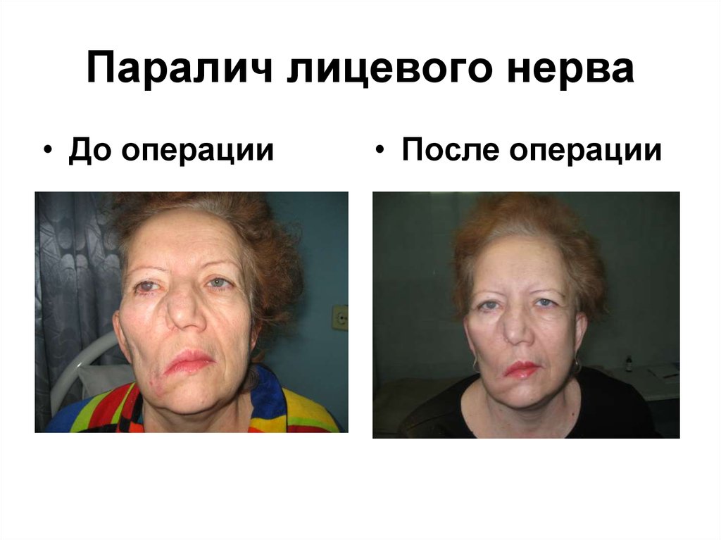 Паралич лицевого нерва фото до и после лечения