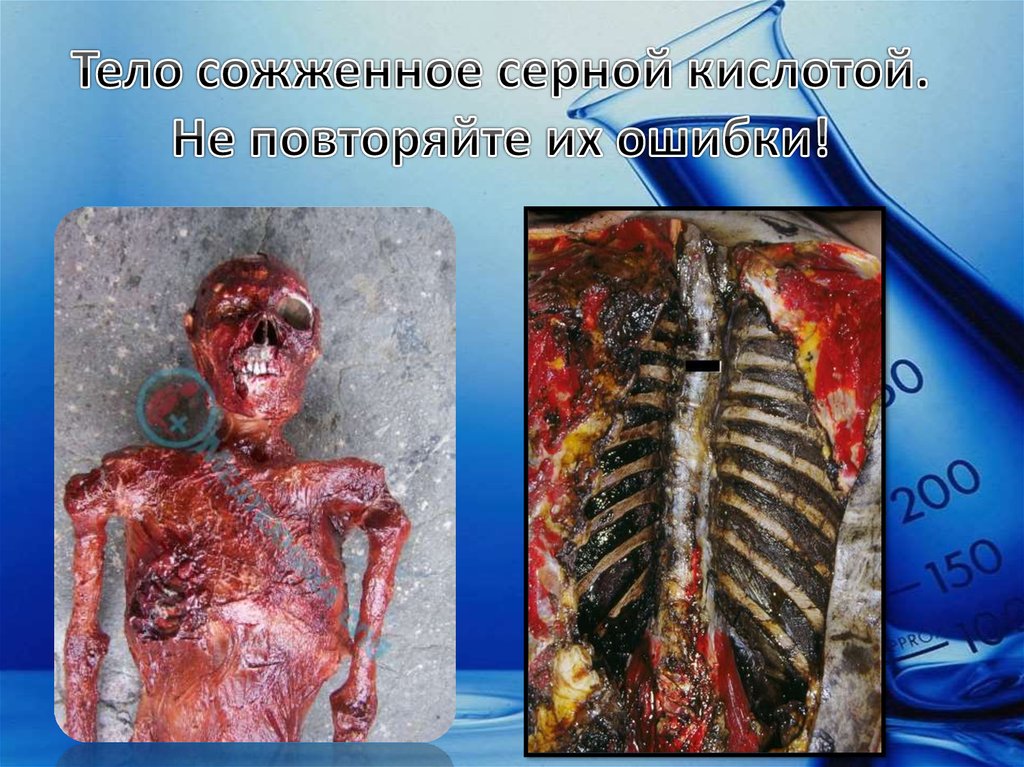 Тело сожженное серной кислотой. Не повторяйте их ошибки!
