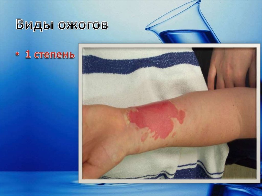 Виды ожогов