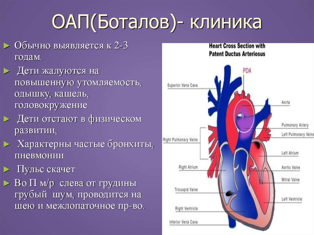 Оап у новорожденных. Открытый артериальный (боталлов) проток (ОАП). Открытый артериальный проток Баталов. Врожденный порок сердца открытый артериальный проток. Клинические проявления открытого артериального протока.