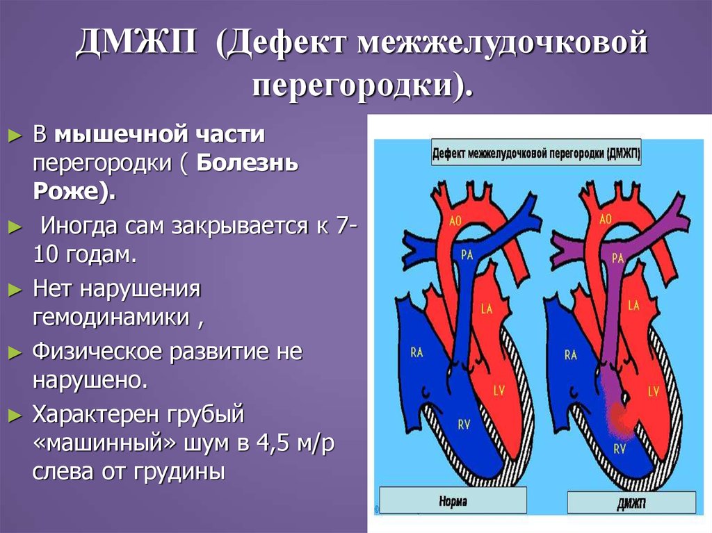 Дефект межжелудочковой перегородки у детей фото