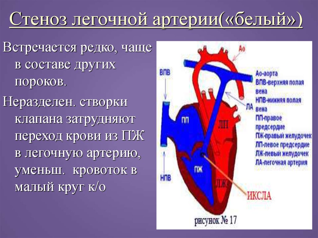 Стеноз легочной артерии. Стеноз легочного клапана гемодинамика. Врожденный клапанный стеноз легочной артерии мкб. Изолированный стеноз легочной артерии гемодинамика. Изолированный стеноз устья легочной артерии.гемодинамика.