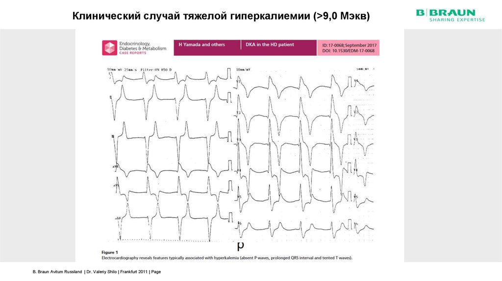 Клинический случай. Гиперкалиемия клинические рекомендации. Постер клинический случай. Гиперкалиемия свыше 6,5 мэкв/л на ЭКГ. Гиперфосфатемия и гипокалиемия при ХБП.