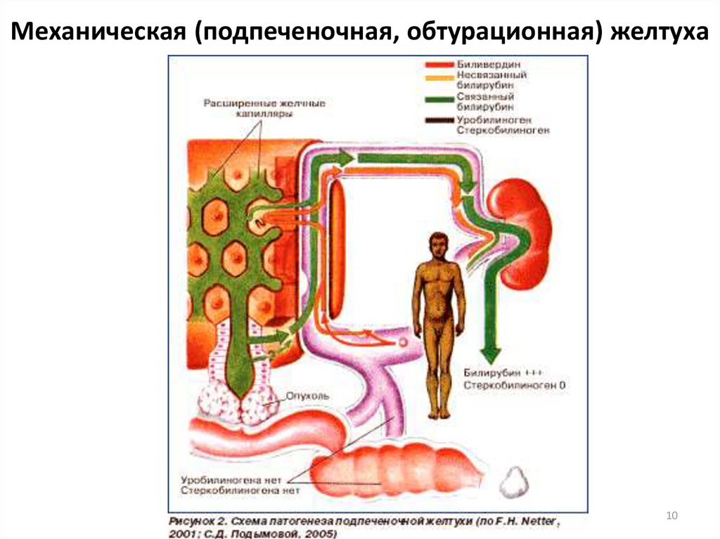 Подпеченочная желтуха схема