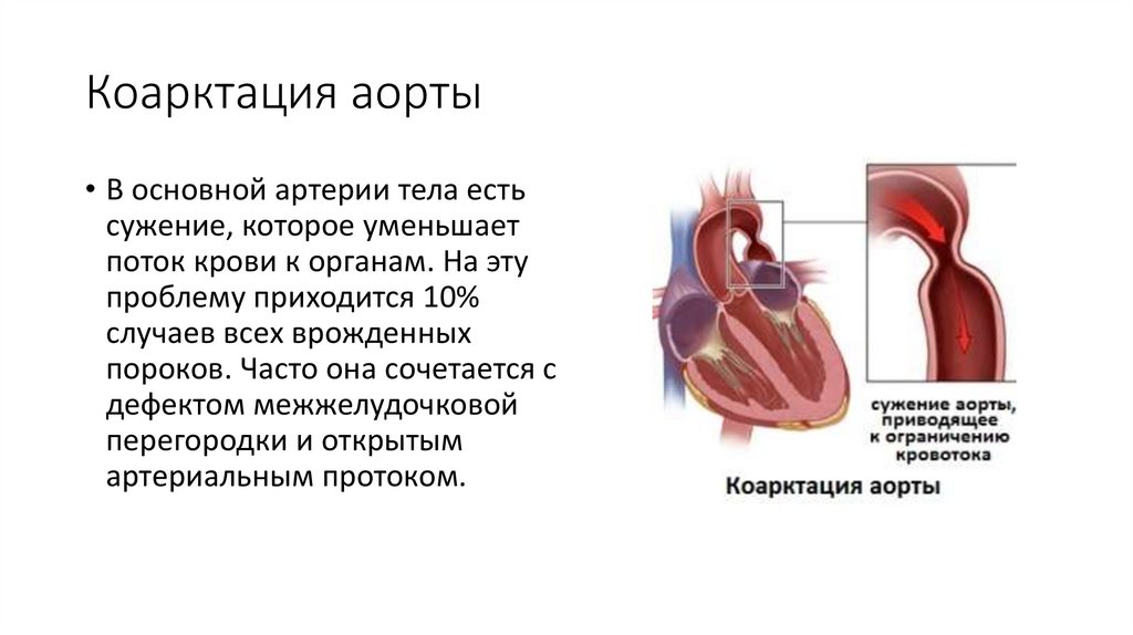 Коарктация аорты фото