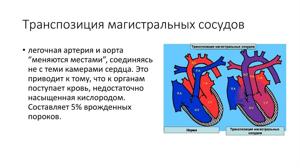 Транспозиция магистральных артерий презентация