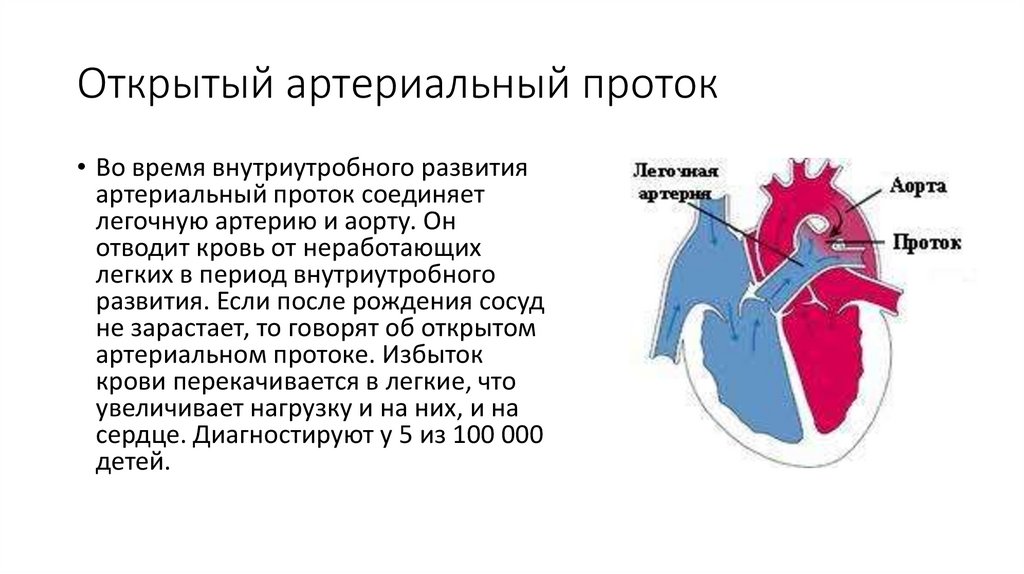 Открытый артериальный проток презентация