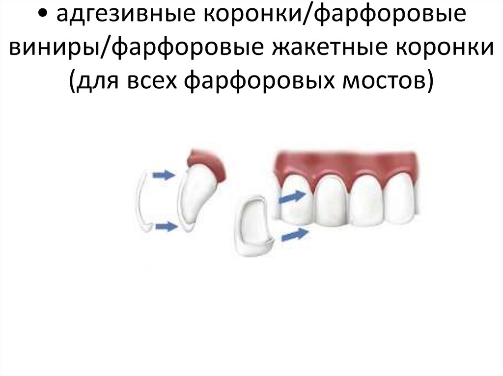 • адгезивные коронки/фарфоровые виниры/фарфоровые жакетные коронки (для всех фарфоровых мостов)