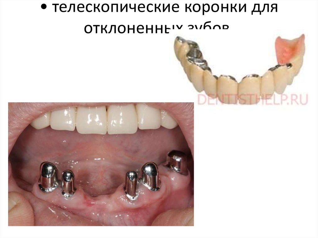 • телескопические коронки для отклоненных зубов.