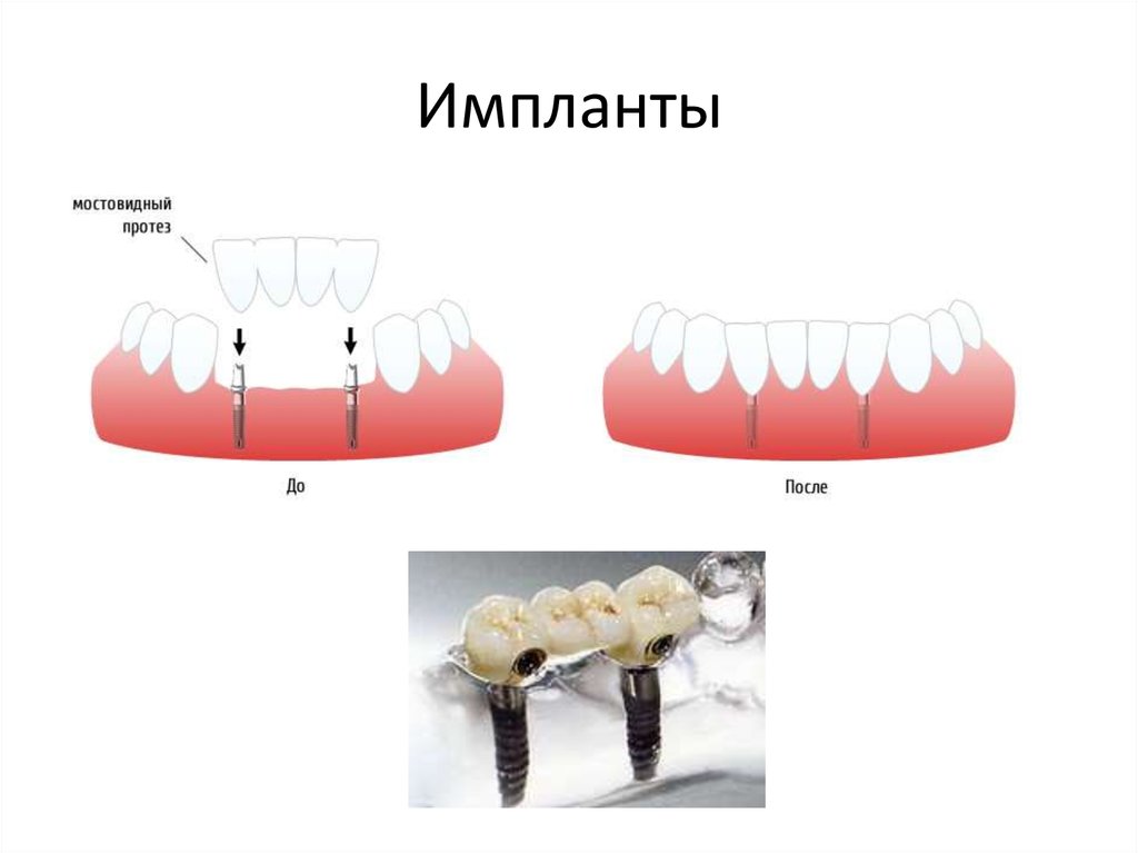 Части мостовидного протеза. Импланты и мостовидные протезы. Консольные мостовидные протезы. Мостовидный протез(под импланты.