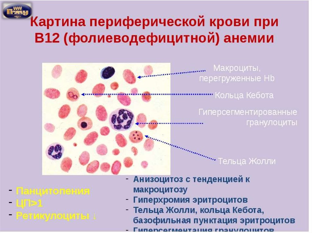 В12 при железодефицитной анемии. Картина крови при в12 дефицитной. В12 фолиеводефицитная анемия картина крови. Морфологические изменения при в12 дефицитной анемии. В12 дефицитная анемия мазок крови.