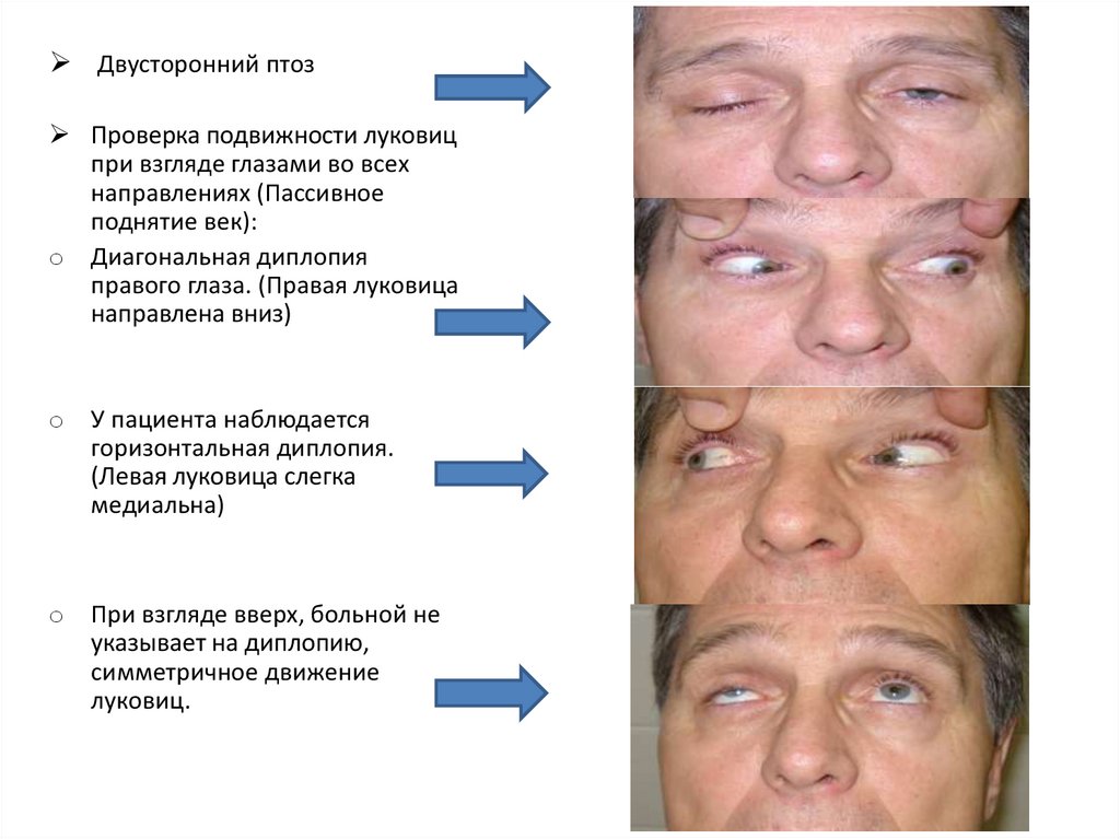 Симптом двоение глаза. Диплопия при взгляде вниз.