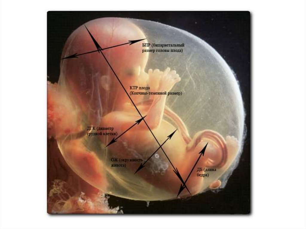 Бпр на узи при беременности. Бипариетальный размер головки. Бипариетальный размер головы плода. Что такое бипариетальный размер плода на УЗИ. Бипариетальный диаметр.