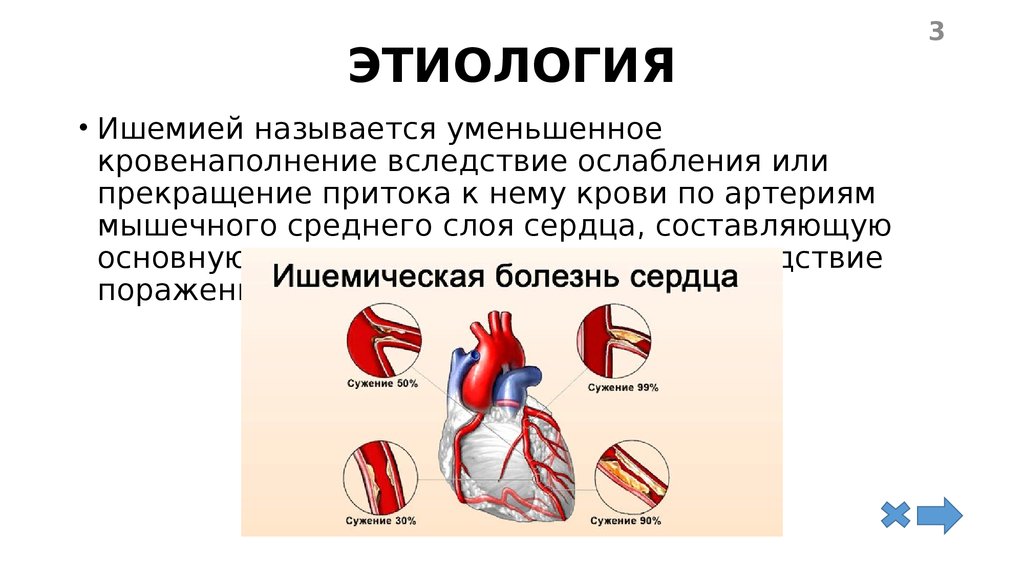 Легкая ишемия. Ишемическая болезнь сердца. Патогенез заболевания.. Этиология ишемии. Ишемическая болезнь этиология.