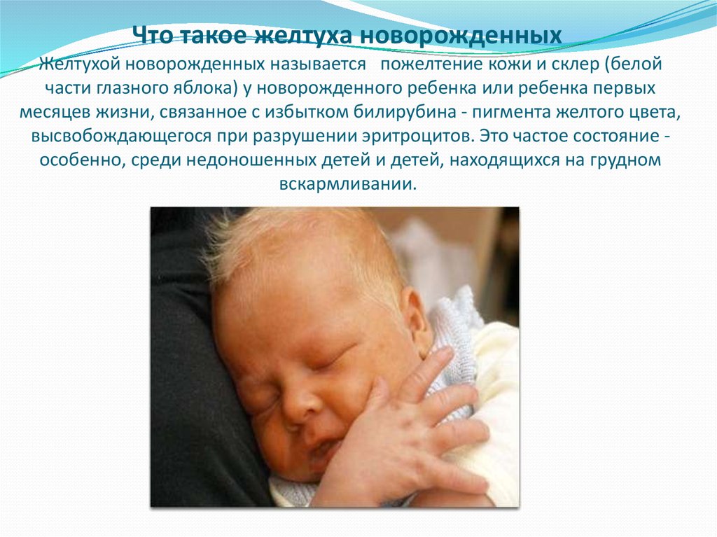 Желтуха новорожденных отзывы. Желтушка у новорожденных. Физиологическая желтуха новорожденных. Что такое желтушка у новорожденных детей. Желтуха у недоношенных детей.