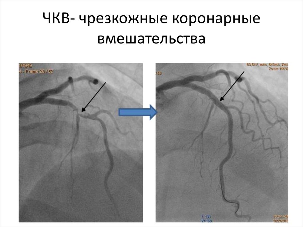 Чкв в кардиологии. Коронарная артерия ЧКВ. Чрескожное вмешательство на коронарных артериях.