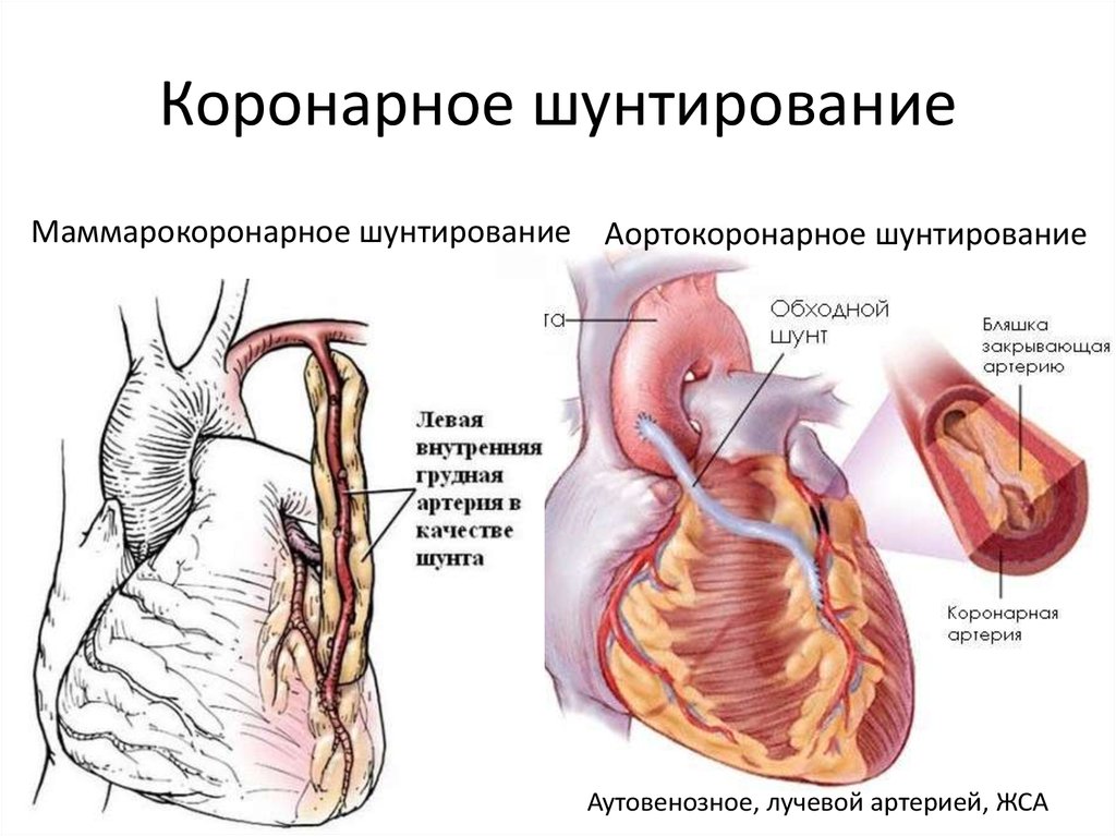 Что такое шунтирование сердца и сосудов. Схема операции аортокоронарного шунтирования. Аорто маммарокоронарное шунтирование. Коронарное шунтирование схема. Аортокоронарное шунтирование этапы операции.