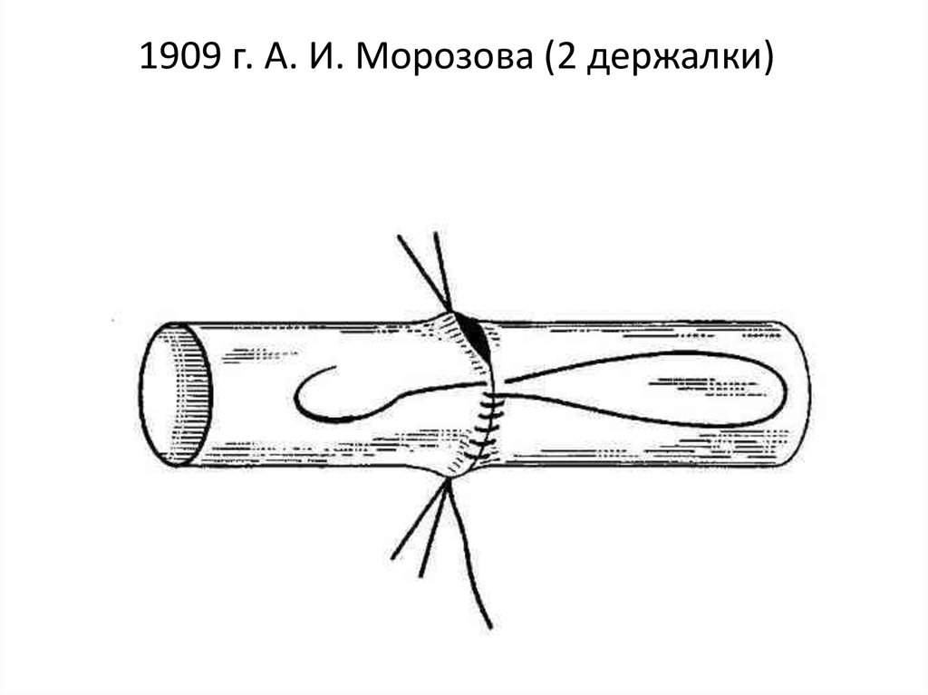 Фистула гемодиализ схема