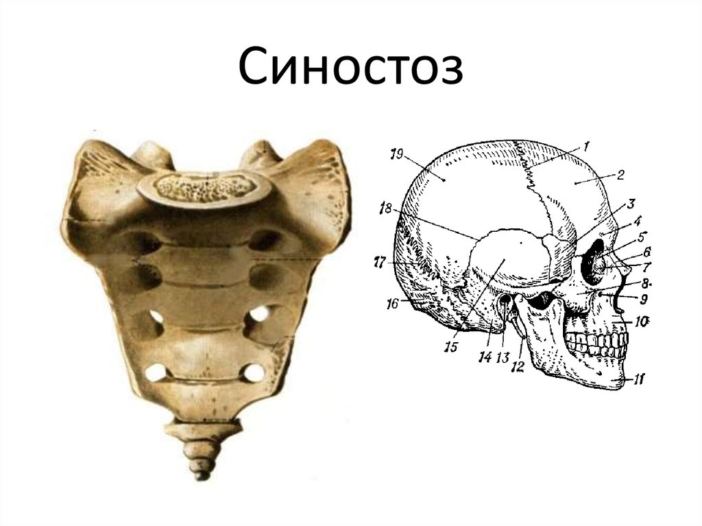 Крестец скелета. Синостоз крестца. Синостоз крестцовых позвонков. Синостоз позвонков копчика.