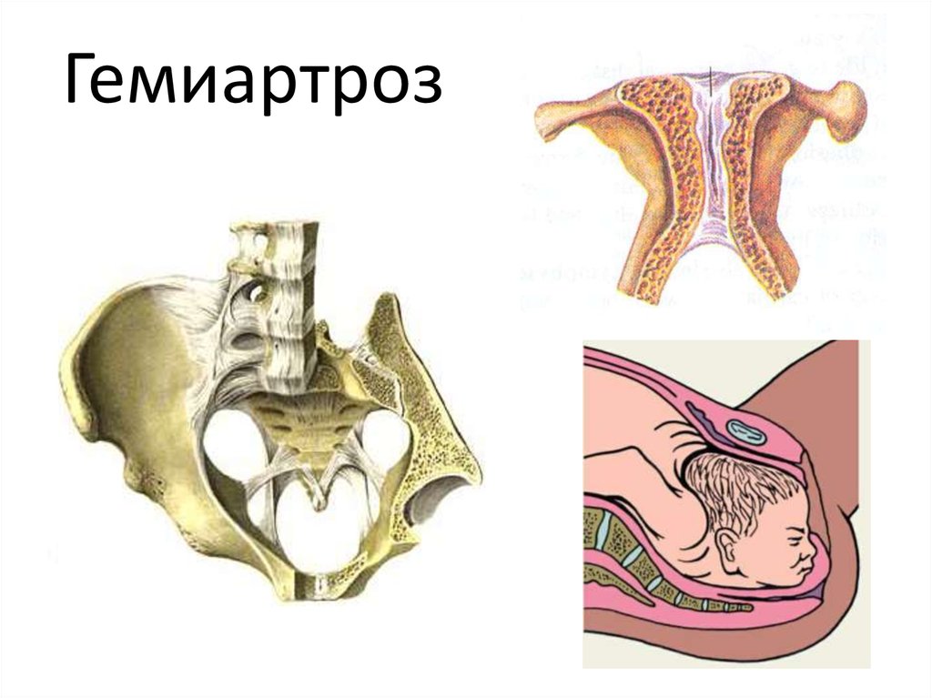 Симфиз это в анатомии. Гемиартрозы. Полусустав гемиартроз. Гемиартрозы симфизы. Строение гемиартроза.