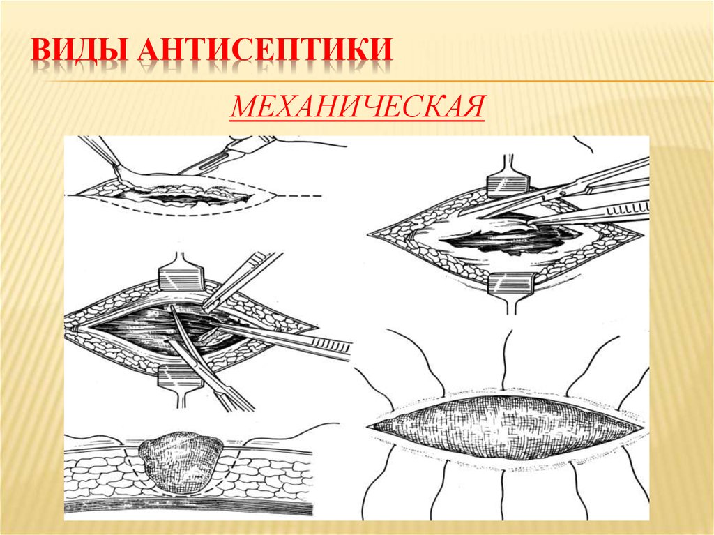 Механическая антисептика. Механическая антисептика в хирургии. Механисечка антисептик. Механическая антисептика методы. Механическая антисептика виды.