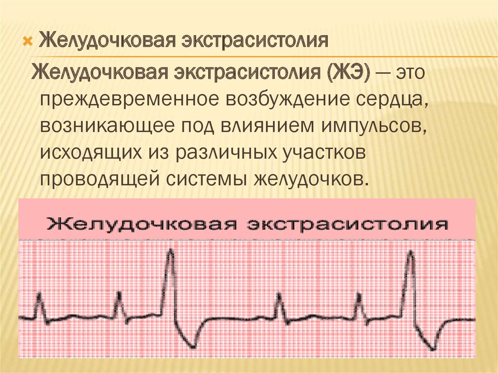 Желудочковые нарушения сердечного ритма рекомендации. Пароксизмальная желудочковая экстрасистолия. Желудочковый ритм сердца. Частая желудочковая экстрасистолия. Желудочковая экстрасистолия локализация.