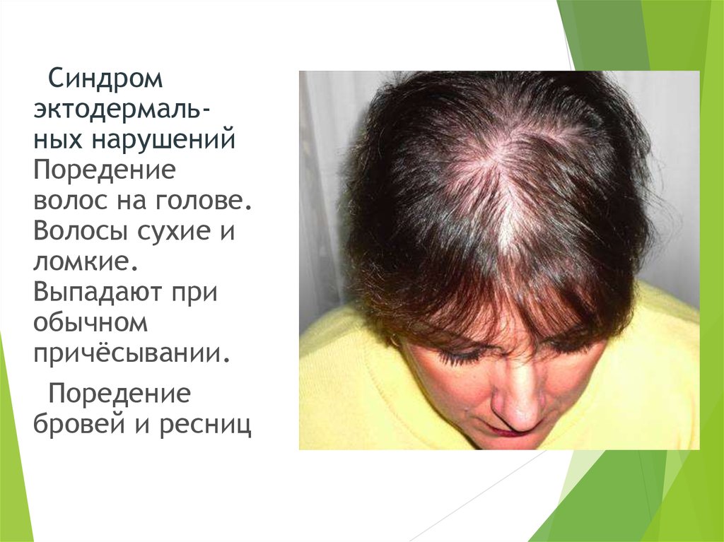 Отечность выпадение волос. Гипотиреоз выпадение волос. Гипотиреоз и облысение у женщин. Выпадают волосы при гипотиреозе.