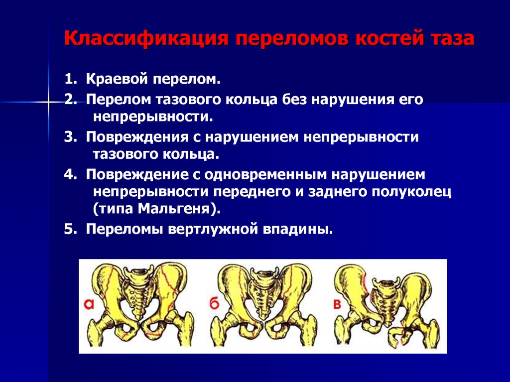 Классификация переломов костей таза