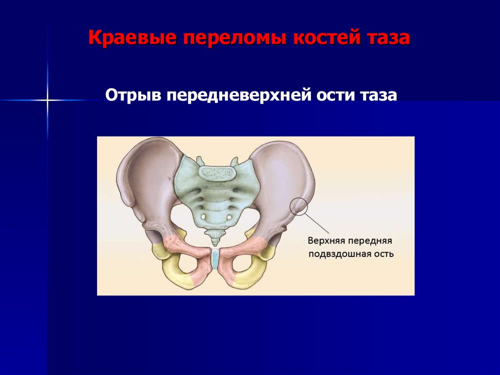 Передние ости подвздошных костей