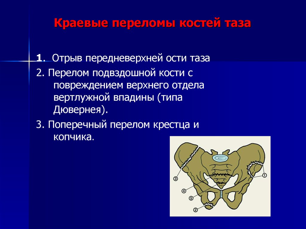 Переломы костей таза презентация