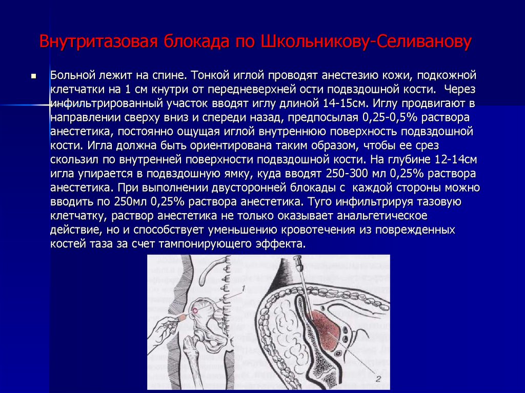 Метод школьникова. Внутритазовая новокаиновая блокада по Школьникову. Техника внутритазовой блокады по Школьникову Селиванову. Блокада по Школьникову Селиванову Цодыксу. Новокаиновая блокада по Школьникову-Селиванову.