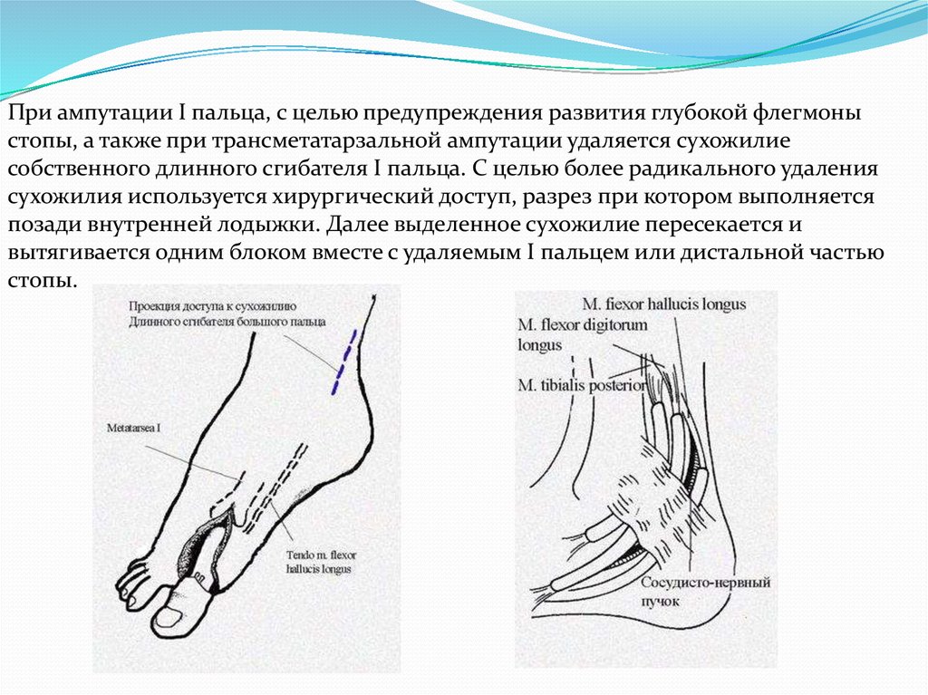 Ампутация пальцев мкб 10. Разрезы при флегмоне 1 пальца стопы. Вскрытие флегмоны тыла стопы. Плантарная флегмона стопы.