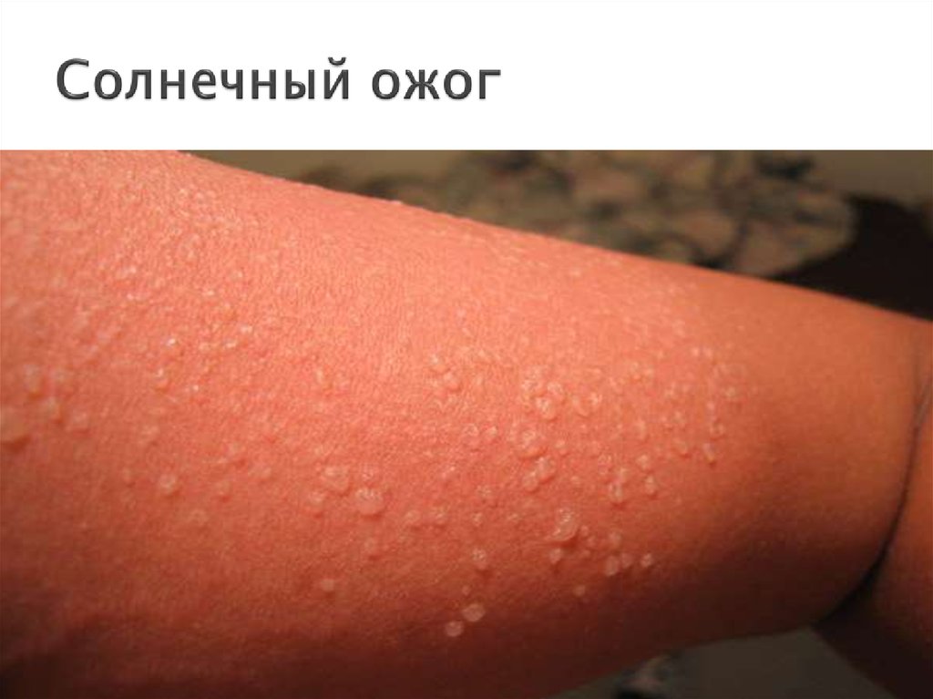 Солнечный ожог