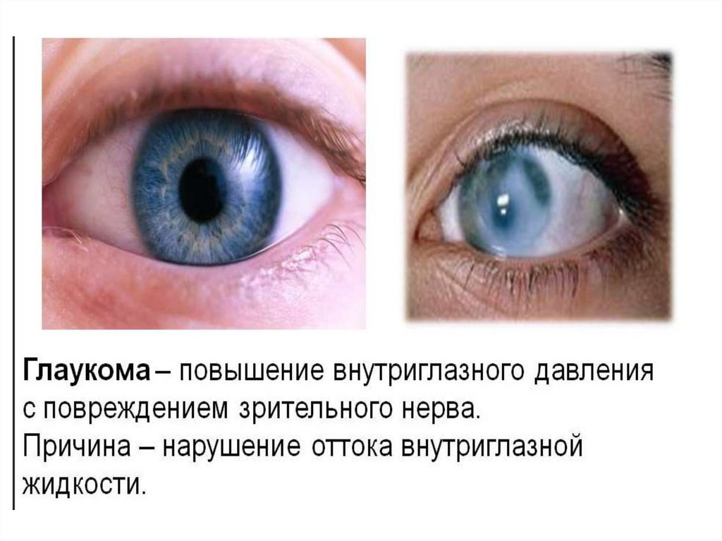 Что делать при глаукоме глаза