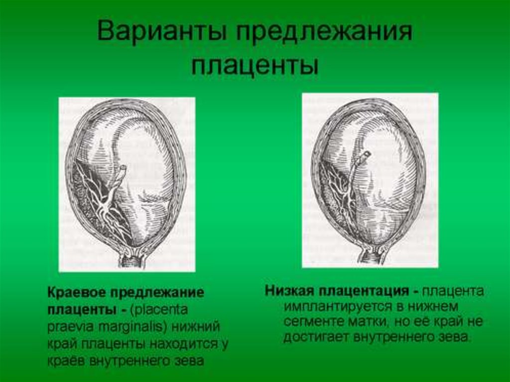 Предлежание плаценты картинки