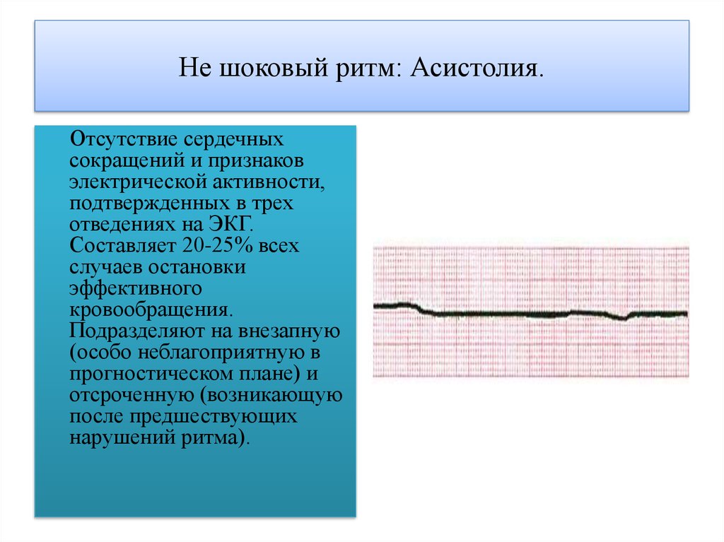 Асистолия сердца это