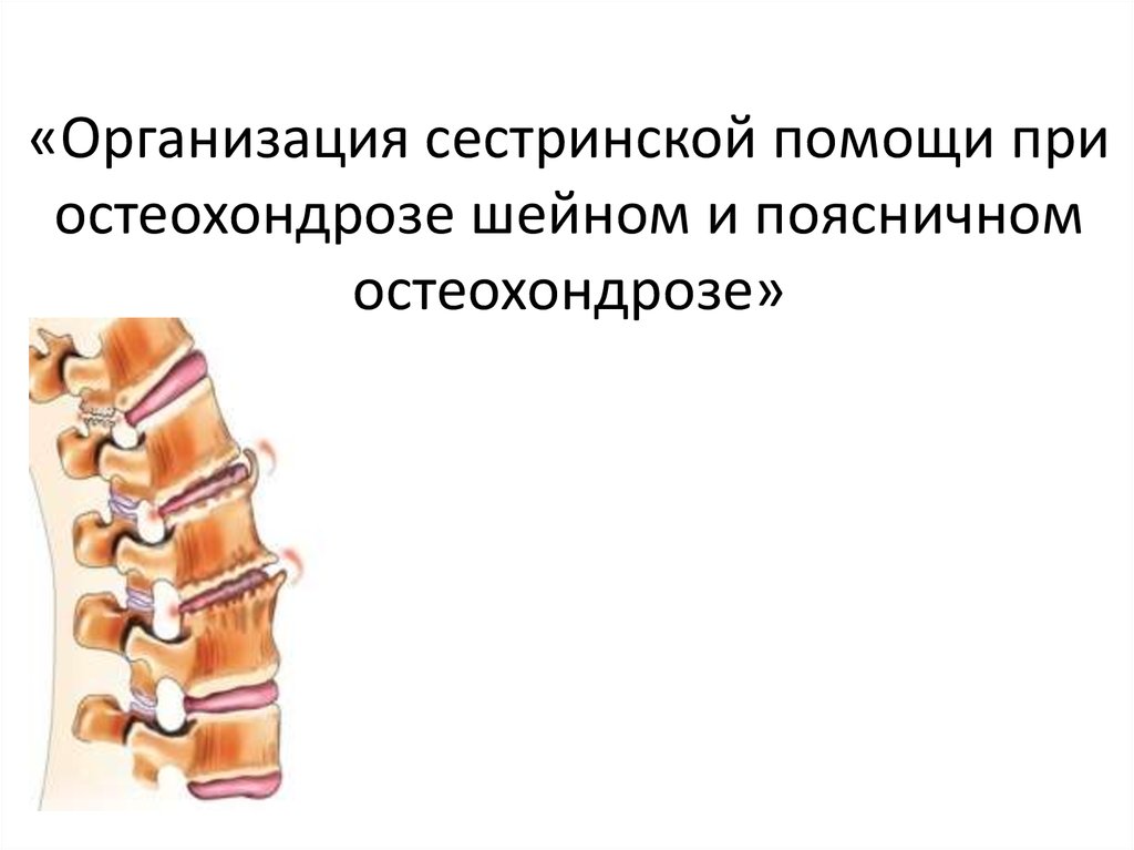 Остеохондроз берут. Шейный остеохондроз презентация. Сестринская помощь при остеохондрозе. Обострение остеохондроза. Сестринский процесс при межпозвоночном остеохондрозе.