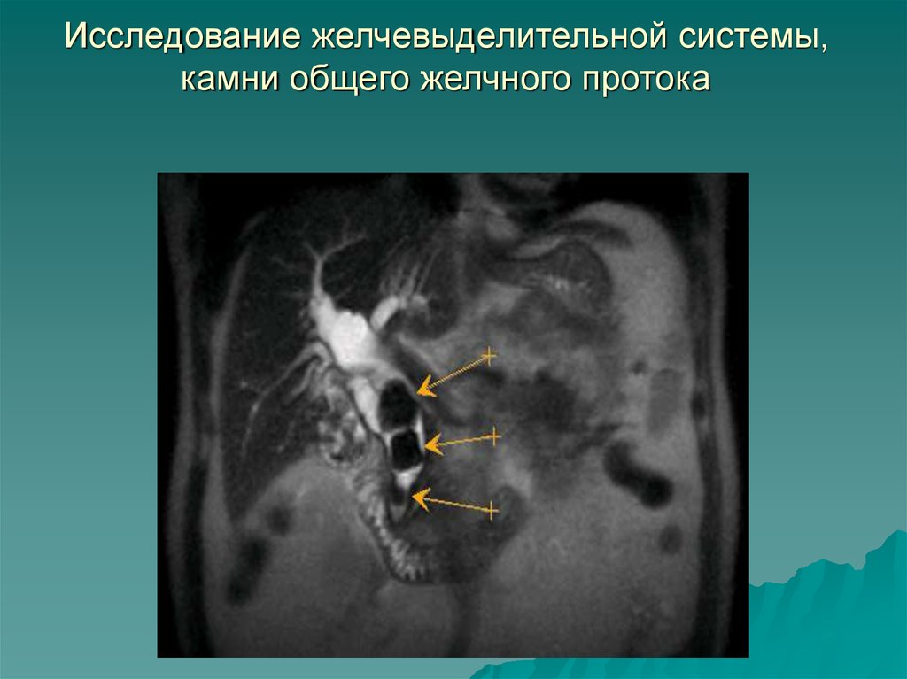 Фото желчных протоков