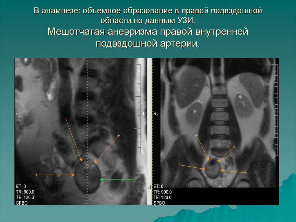 Правая подвздошная