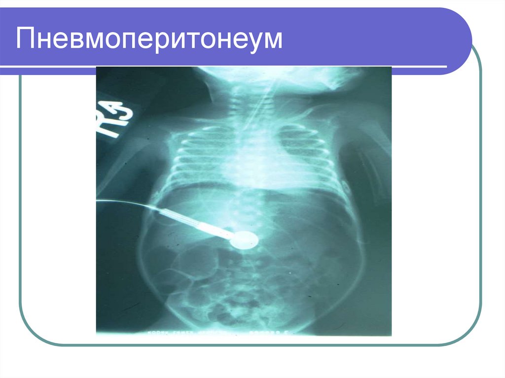 Перфорация кишечника симптомы