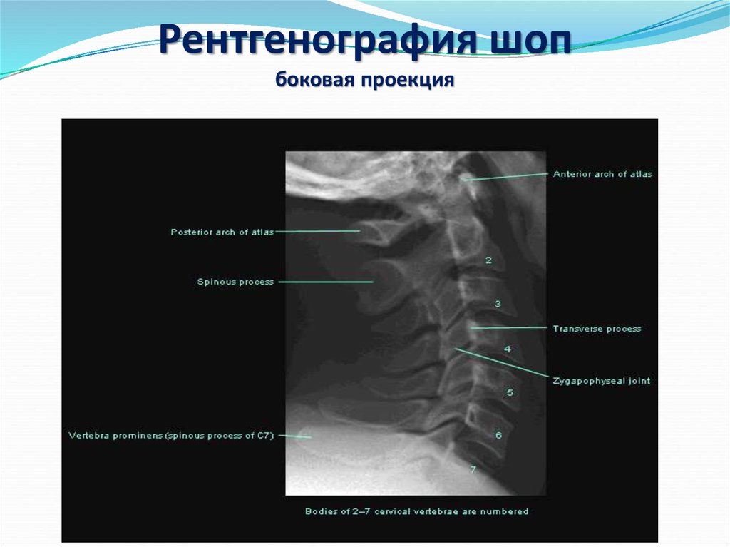 Рентгенограмма в боковой проекции. Рентген боковой проекции шеи норма. Шейный отдел позвоночника рентген норма. Рентген шейного отдела в 2 проекциях.