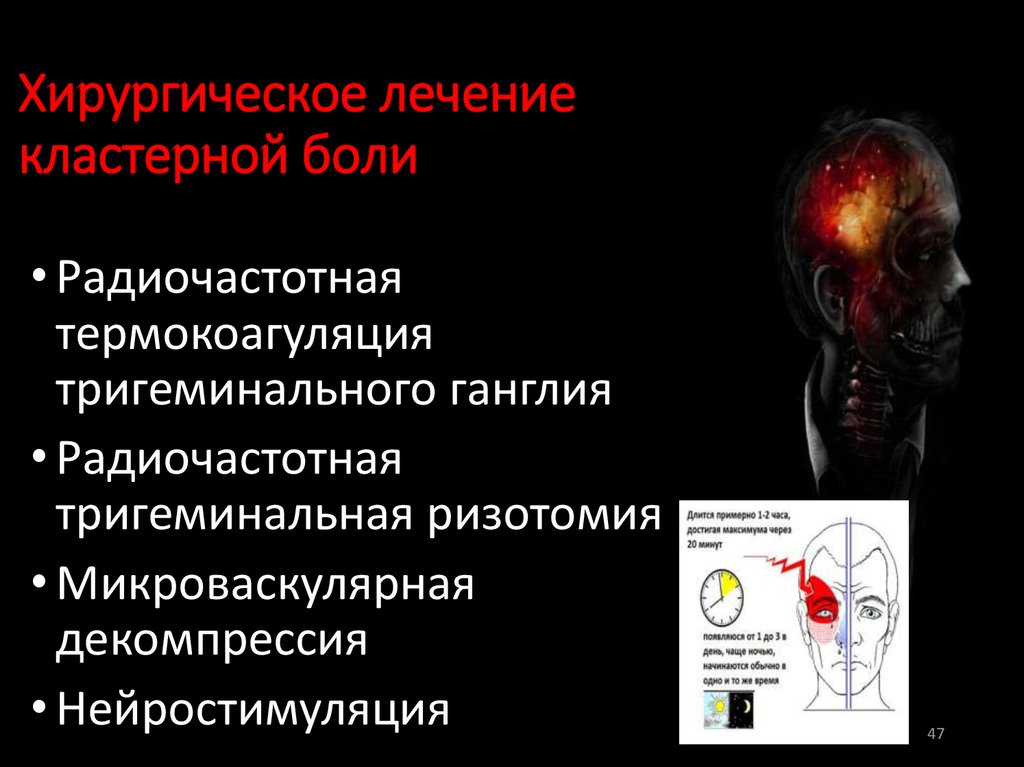 Кластерные боли