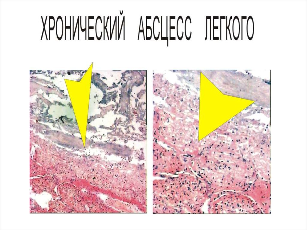 Воспаление патанатомия презентация