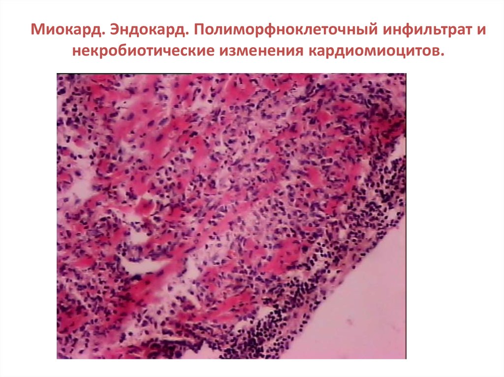 Полиморфноклеточная инфильтрация