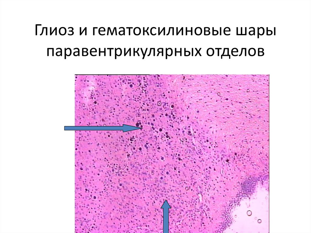 Меланома микропрепарат рисунок