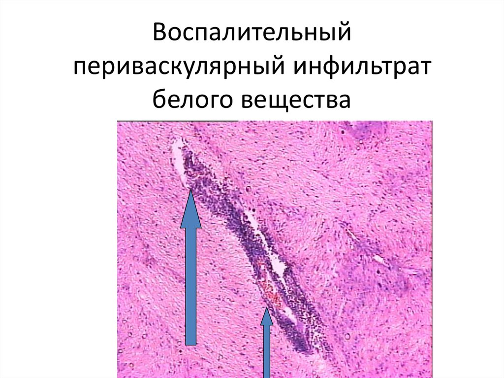 Инфильтрат это