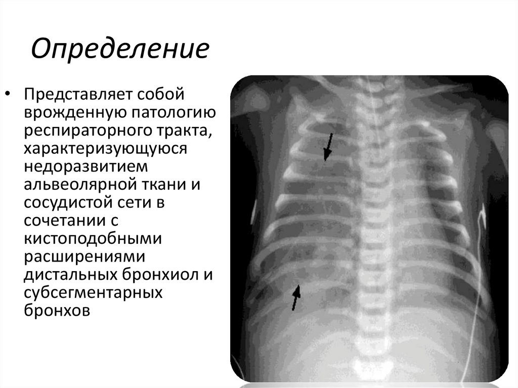 Гипоплазия легкого презентация