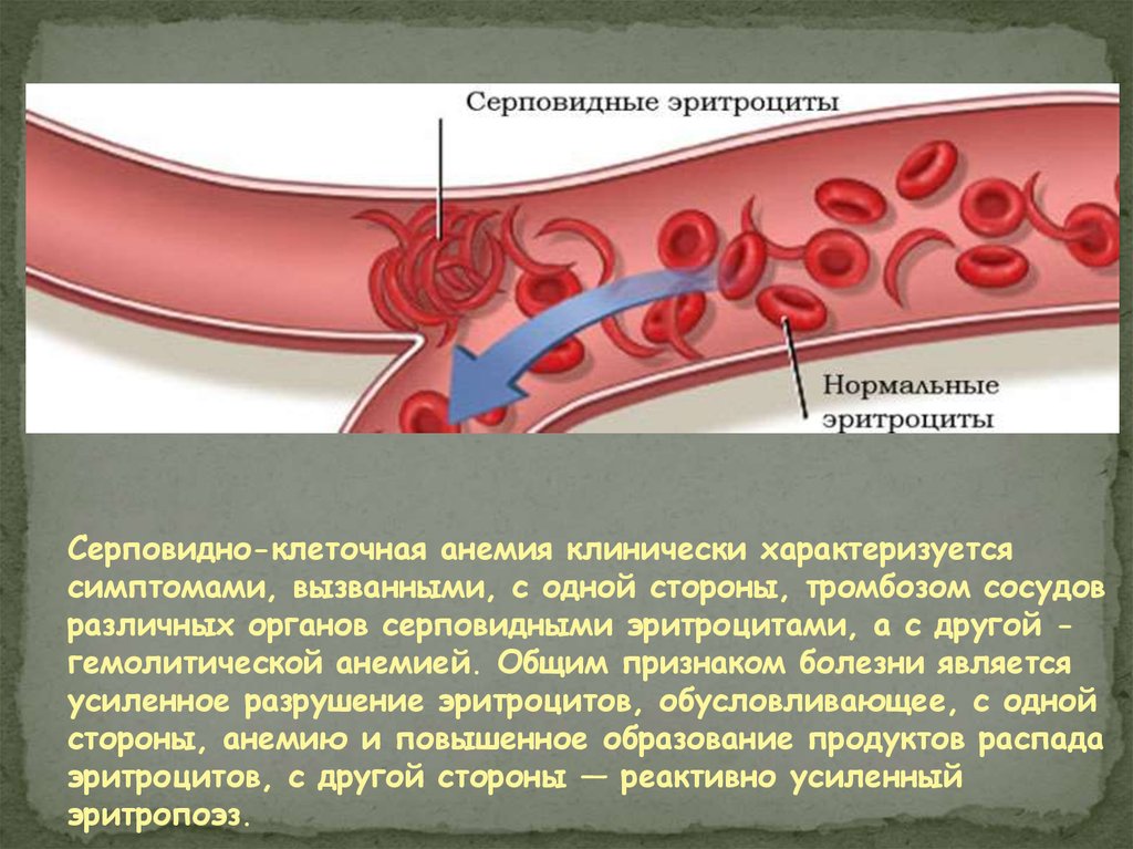 Эритроциты при серповидно клеточной анемии. Серповидноклеточная анемия эритроциты. Серповидная клеточная анемия симптомы. Эритроциты при серповидноклеточной анемии. Серповидноклеточная анемия характеризуется.