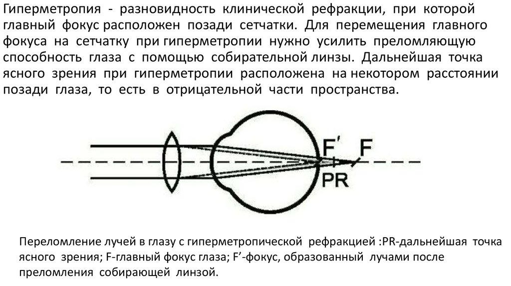 Гиперметропия глаза что это такое у взрослых. Гиперметропия у детей клинические рекомендации. Главный фокус при гиперметропии расположен. Гиперметропия рекомендации. Виды гиперметропии.