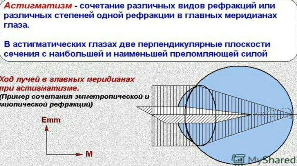 Диапазон рефракции. Ход лучей в астигматическом глазу. Главные меридианы астигматического глаза это. Главные меридианы астигматизма это. Сложный миопический астигматизм 1 степени.